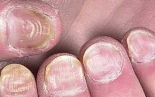 Болезнь ногтя большого пальца