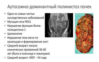 Как развивается поликистоз почек — профилактика заболевания