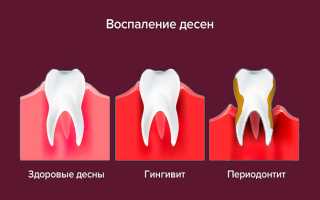 Почему поднялась десна над зубом — чем опасно заболевание