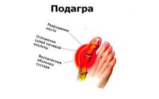 Боль в большом пальце ноги — эффективные методы лечения
