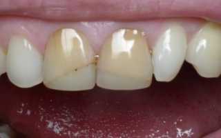 Реставрация зубов — эффективные методы восстановления красивой улыбки