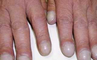 Вид ногтей и заболевания