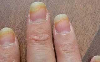 Болезни ногтей у детей на руках