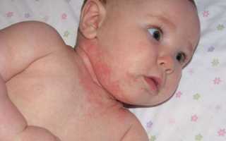 Атипичный дерматит у детей