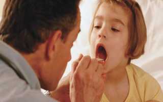 Вирусный и ложный круп у детей: симптомы и лечение