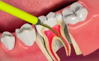 Больно ли удалять нерв из зуба?