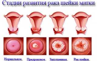 Как быстро развивается рак шейки матки: симптомы и признаки