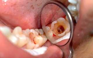 Болит зуб без нерва