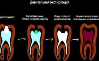 Ампутация пульпы зуба: витальный и девитальный способы