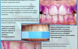 Реминерализация зубов