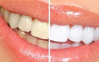 Гигиеническая чистка зубов — для чего нужна, виды и цены процедур