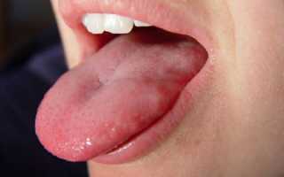 Стоматит на языке — чем лечить?