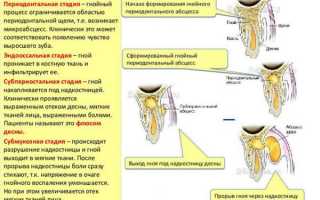 Периостит челюсти: симптомы, лечение, профилактика