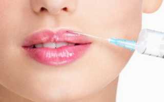 Филлер для губ: какой препарат лучше для увеличения губ, коррекция, название препаратов