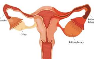 Боль в области яичников у женщин причины