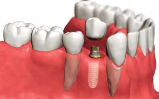 Зубные импланты: противопоказания для установки