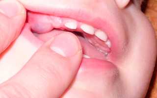 Прорезывание коренных зубов у детей: симптомы