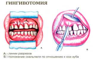 Гингивэктомия в стоматологии — хирургический способ решения проблемы пародонтита