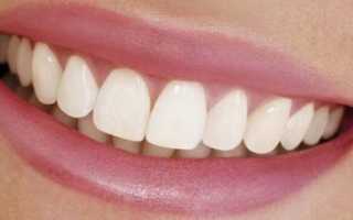 Как ставят виниры на зубы — методы и рекомендации стоматологов