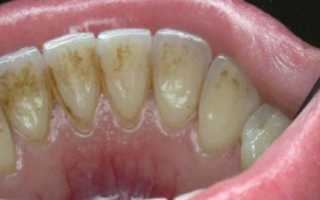 Чистка зубов от зубного камня — методики, цены и мнения пациентов
