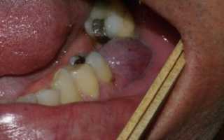 Гранулема зуба — причины и способы лечения