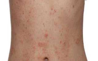 Аллергический дерматит у взрослых симптомы