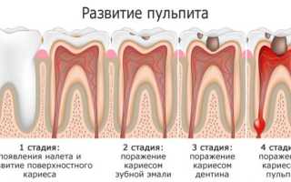 Болит зуб после лечения пульпита