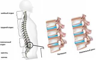 Боль в позвоночнике посередине спины — когда требуется срочная помощь