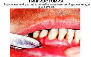 Гингивотомия в стоматологии — хирургический способ решения проблемы пародонтита