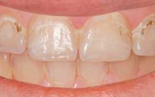 Как лечат кариес зубов — эффективные методики в детском и взрослом возрасте