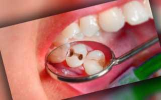 Как успокоить зубную боль в домашних условиях