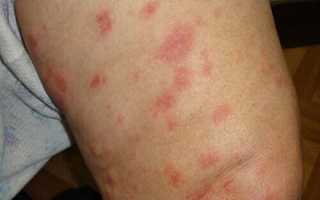 Аллергический дерматит симптомы