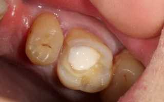 Как делают пломбу на зуб