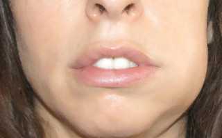 Воспаление надкостницы зуба: симптомы