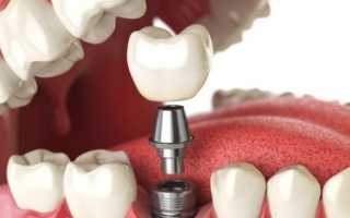 Чем отличается протезирование от имплантации зубов?