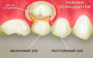 Как выглядят акульи зубы у человека — лечение полиодонтии