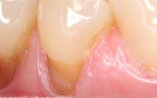 Некариозные поражения зубов — какими они бывают, чем вызваны и насколько опасны