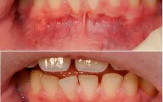 Когда требуется вестибулопластика в стоматологии – методы проведения и возможные осложнения
